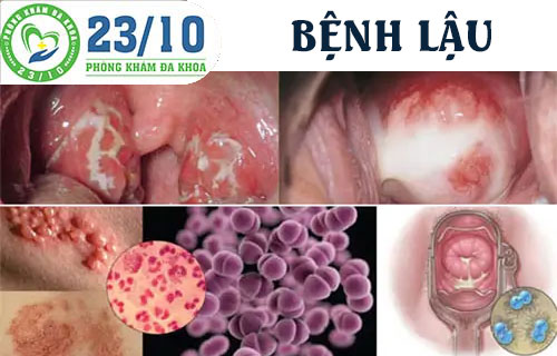 Nổi mụn ở vùng kín do bệnh lậu