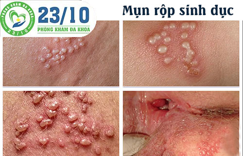 Mụn rộp sinh dục là một trong những căn bệnh hoa liễu khá phổ biến