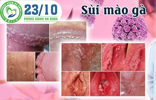 Sùi mào gà là một trong những bệnh hoa liễu gây nổi mụn cơm thường gặp